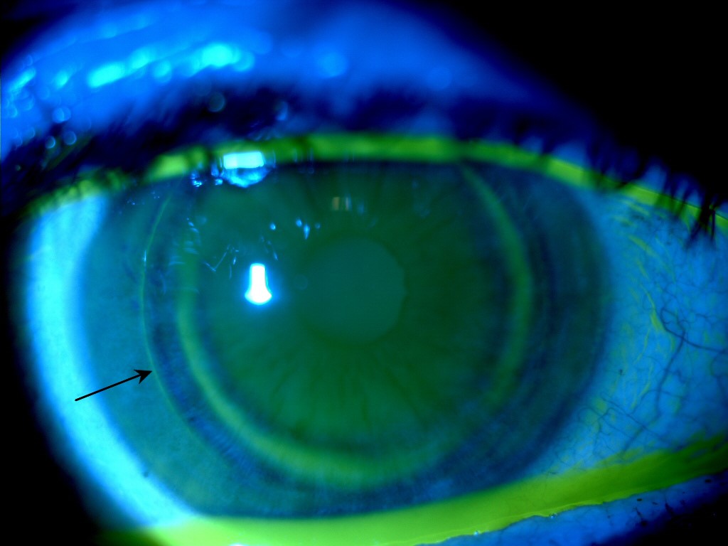visuel post-opératoire de l'oeil après l'opération de chirurgie réfractive LASIK