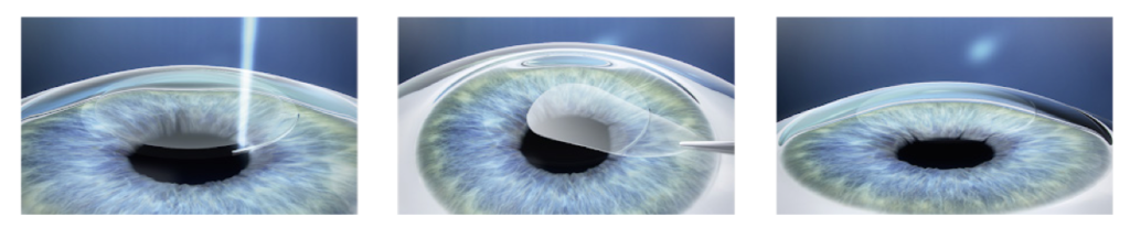 visuel de présentation de l'opération de chirurgie réfractive SMILE