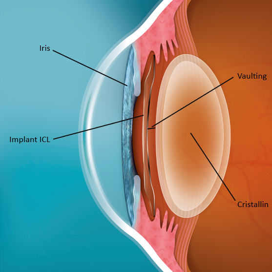 coupe schématisée avec indications d'un oeil vu de profil ou chaque partie est visible notamment le cristallin, le vaulting etc.